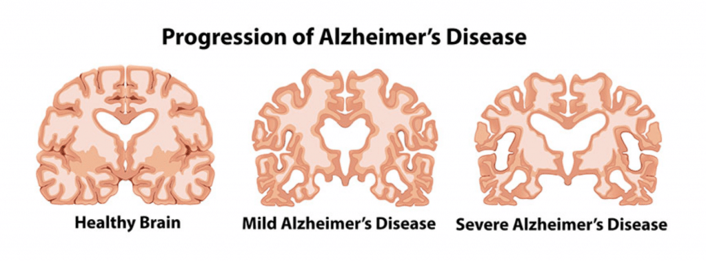 Alzheimers Brain